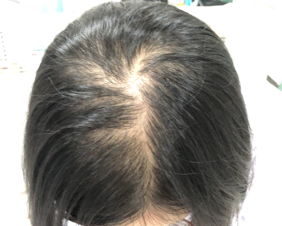 防止脱发要做些什么【惠州广肤皮肤病专科医院怎么样】