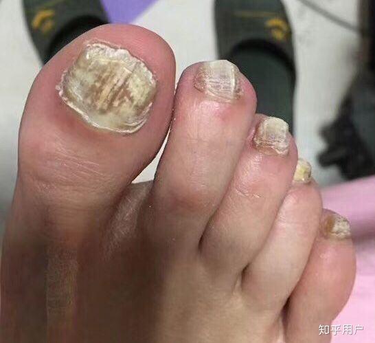 惠州看灰指甲医院,灰指甲症状有哪些,惠州广肤皮肤病专科治疗灰指甲怎么样