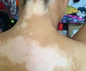 白癜风患者日常该如何护理【惠州广肤皮肤病专科医院怎么样】