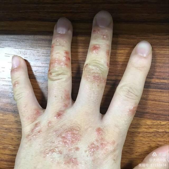 湿疹对身体有什么危害【惠城广肤皮肤病专科医院】