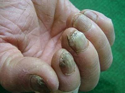 得到灰指甲后有什么可怕的危害【惠州广肤皮肤病专科医院】